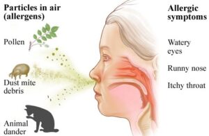 Allergic Rhinitis - AISClinic