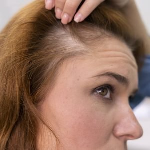 Acute Telogen Effluvium Acute Telogen Effluvium