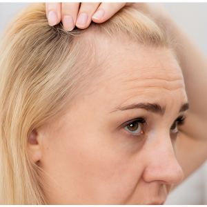 Thinning Hair and Natural Beauty Female Pattern Baldness