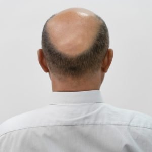 bold-man-needing-follicular-unit-extraction Male Pattern Baldness