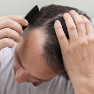mature-man-having-balding-problems mature-man-having-balding-problems