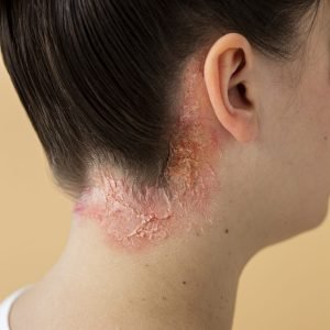 psoriasis psoriasis